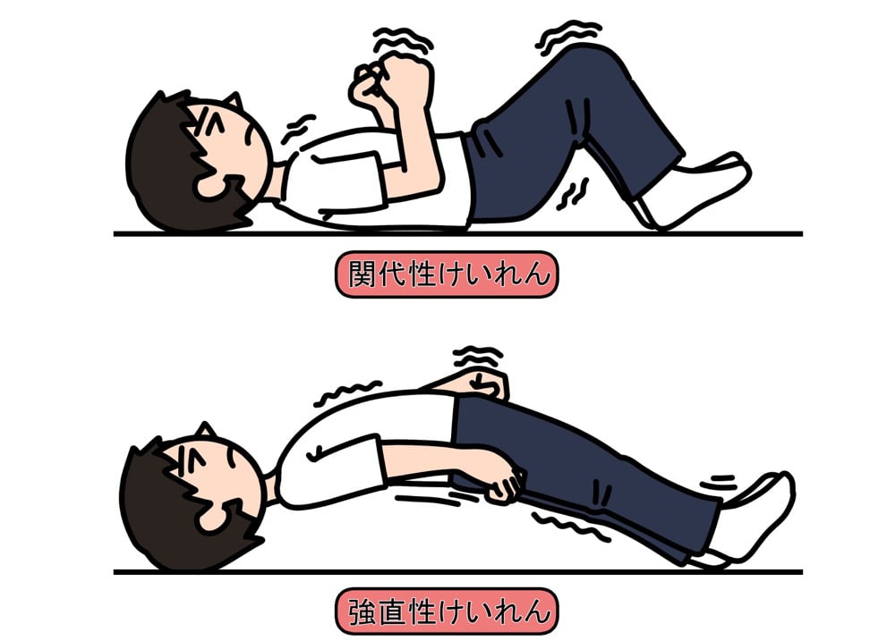がくがく動く間代性のけいれんと、つっぱるような動きの強直性のけいれん