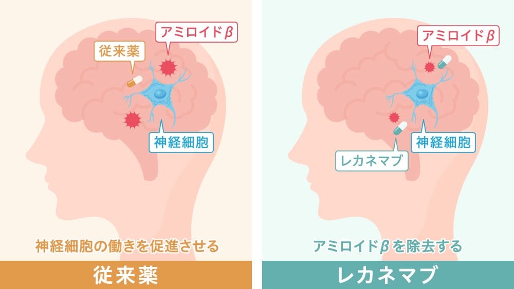 従来薬とレカネマブの違いを表したイラスト。従来薬は神経細胞の働きを促進させるのに対して、レカネマブはアミロイドβを除去する