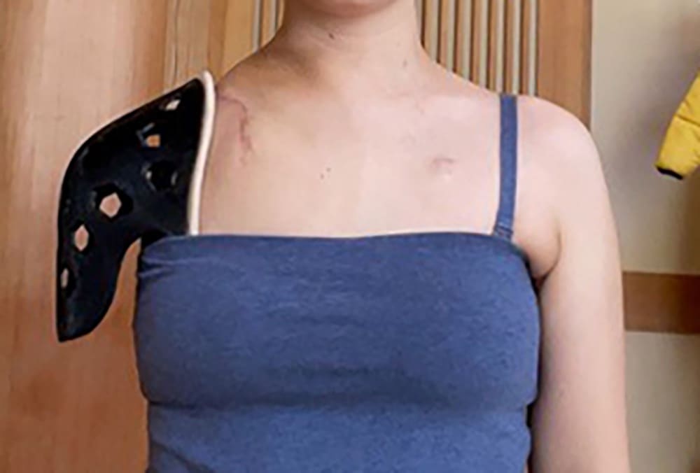 左肩を失った女性が肩パッドをつけている