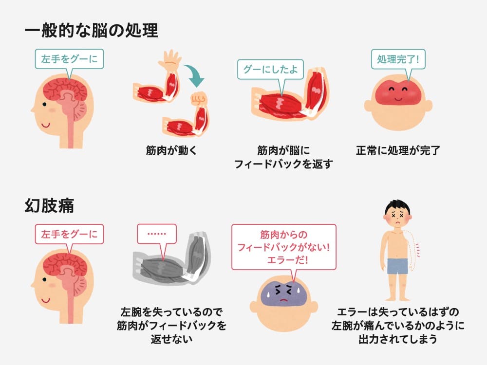 イラスト:
一般的な脳の処理
脳が「左手をグーにして」と指示を出す。
筋肉が動き、左手が握りこぶしをつくる。
筋肉が脳に「グーにした」とフィードバックを返す。
脳は正常に処理が完了し、笑顔の人物が表示される。
幻肢痛
脳が「左手をグーにして」と指示を出すが、腕がないため筋肉がフィードバックを返せない。
脳が「フィードバックがない!」とエラーを感じ、ないはずの左腕に痛みとして出力してしまう。