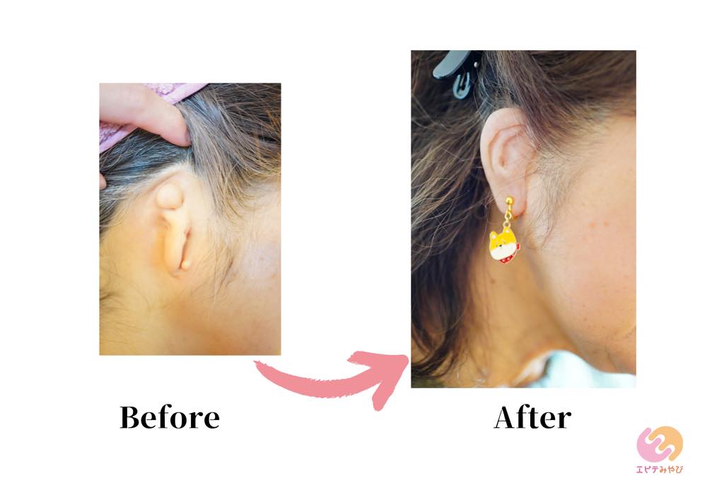 小耳症の方が耳のエピテーゼをつけた様子。エピテーゼにはイヤリングが着けられている