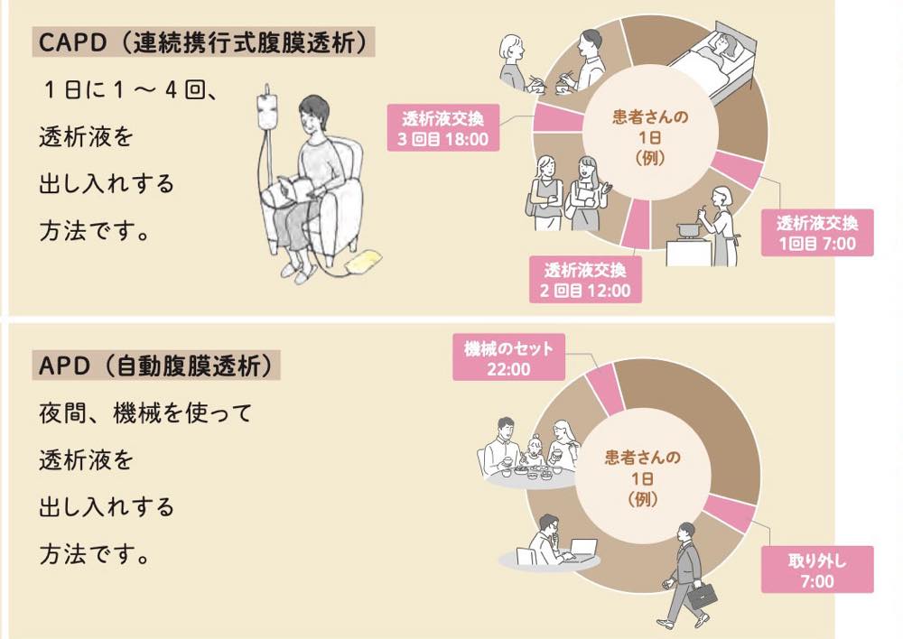 「自動腹膜透析(APD)」と「連続携行式腹膜透析(CAPD)」をしている人の生活例を示す図。「自動腹膜透析(APD)」をしている人の生活例ではは7時・12時・18時に透析液交換を行っている。「連続携行式腹膜透析(CAPD)」をしている人の生活例では、7時の起床時に透析液を出し入れする機械を取り外し、22時の就寝前に機械をセットしている。