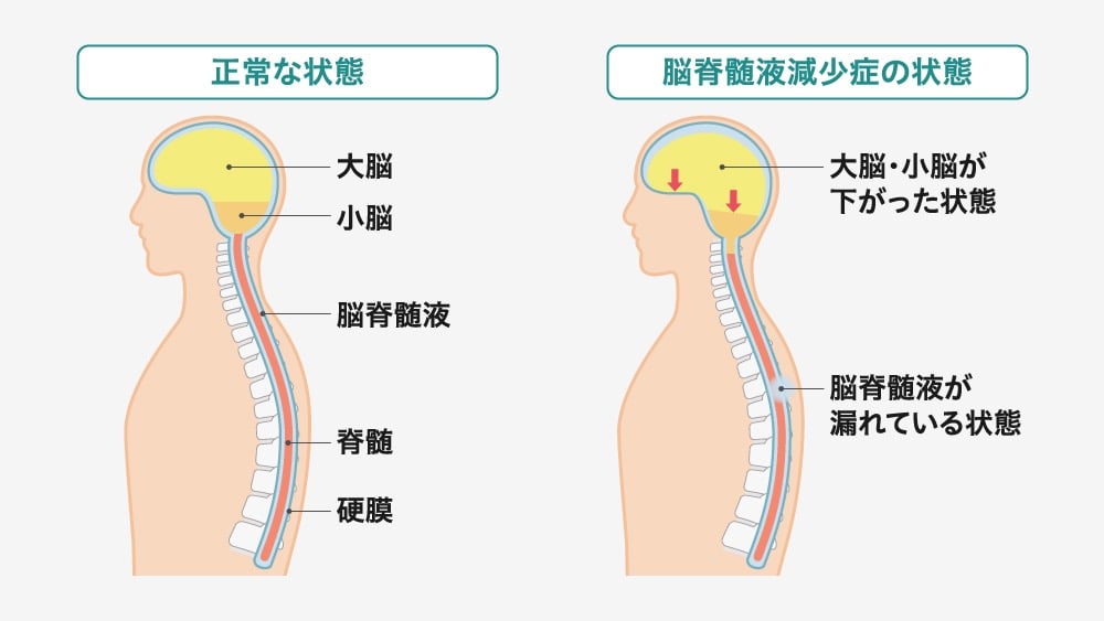 脳脊髄液減少症の説明図。左側は正常な状態で大脳、小脳、脳脊髄液、脊髄、硬膜。右側は脳脊髄液減少症の状態で、大脳・小脳が下がり、脳脊髄液が漏れている様子を表している
